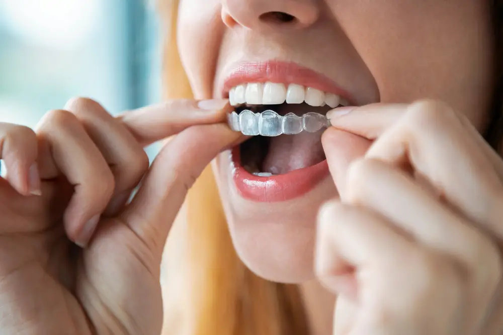 How Does Invisalign Work Compared To Traditional Braces?